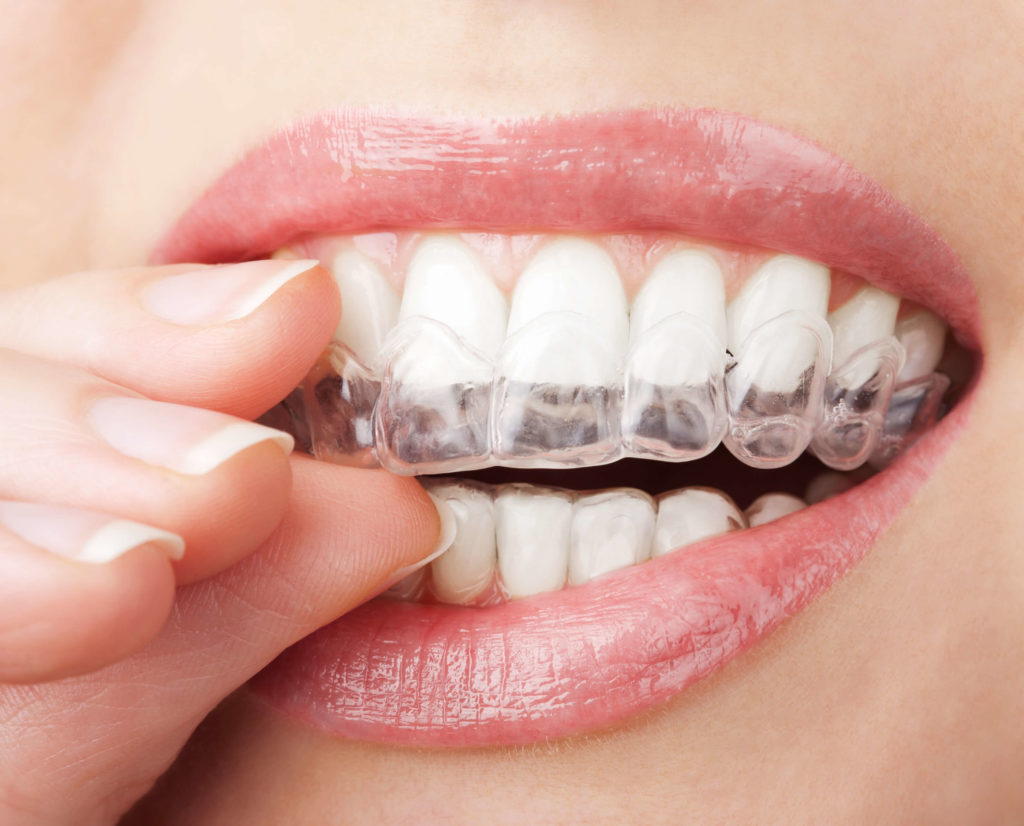 Invisible Braces Annapolis MD