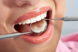 Dental Fillings in Annapolis Maryland