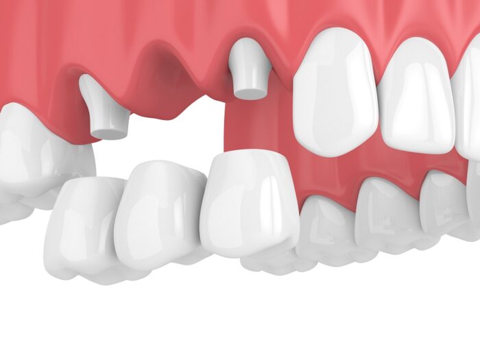 A DENTAL BRIDGE in Annapolis MD could help restore your bite if cared for properly