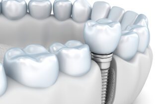 DENTAL IMPLANTS in ANNAPOLIS MD aren't available for every patient
