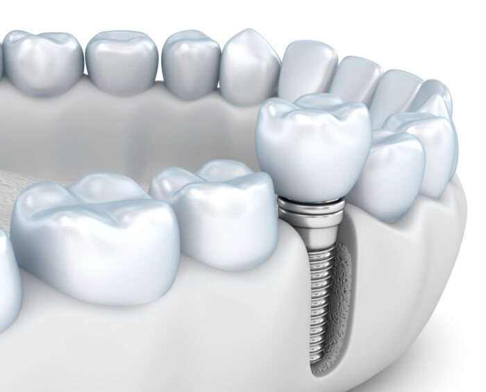 DENTAL IMPLANTS in ANNAPOLIS MD aren't available for every patient