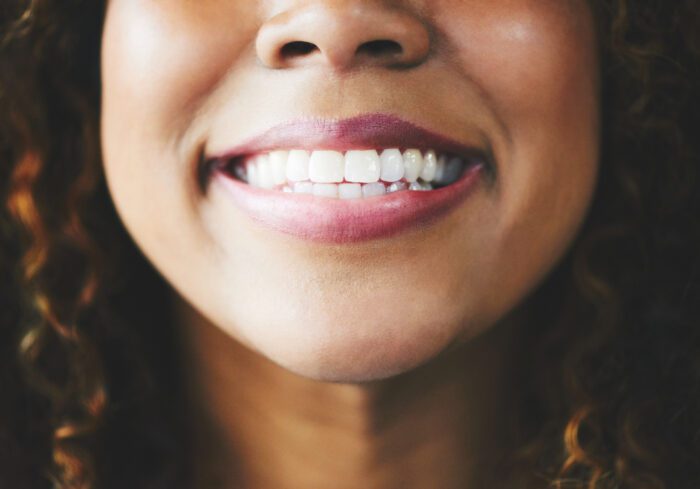 PORCELAIN VENEERS in ANNAPOLIS MD can fix many issues, but they may not be for everyone